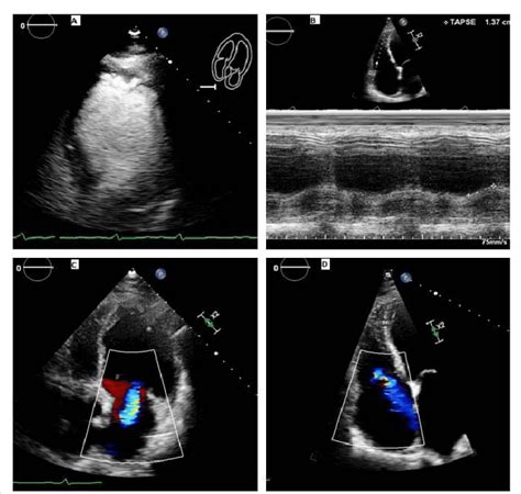 severe left ventricular hypokinesis.